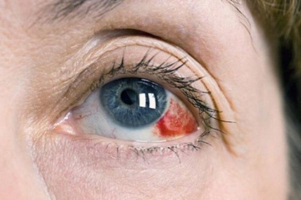لکه های قرمز چشم چه رازهایی درباره سلامت شما دارند؟